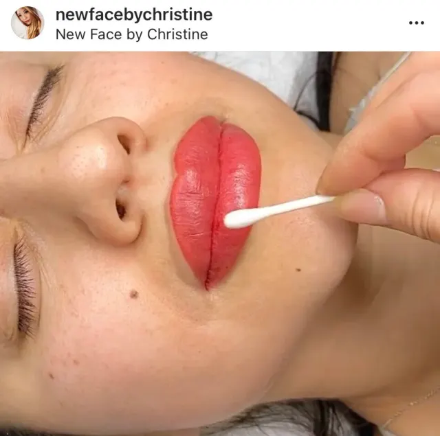 Dark Lips Neutralization result by New Face by Christine, NYC — photo 206