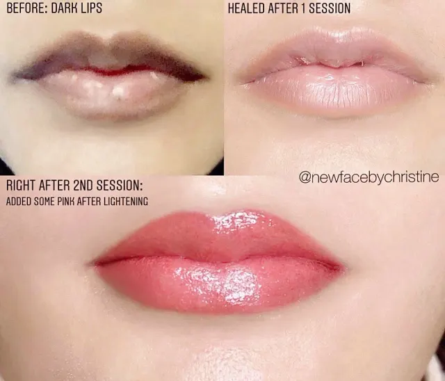 Dark Lips Neutralization result by New Face by Christine, NYC — photo 207