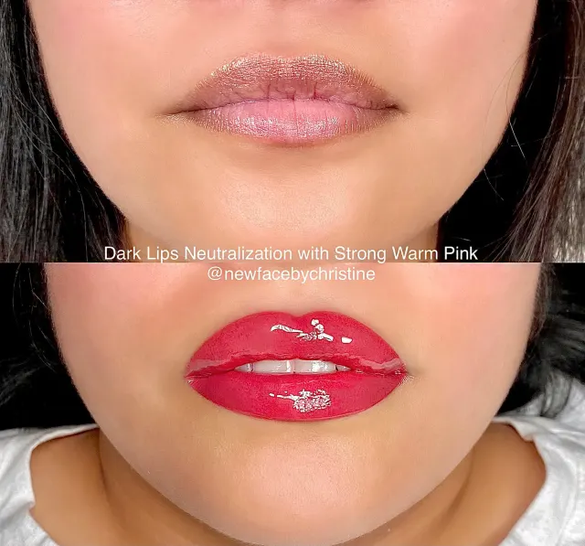 Dark Lips Neutralization result by New Face by Christine, NYC — photo 210