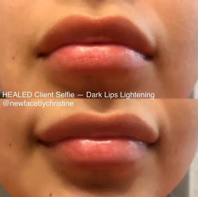 Dark Lips Neutralization result by New Face by Christine, NYC — photo 211