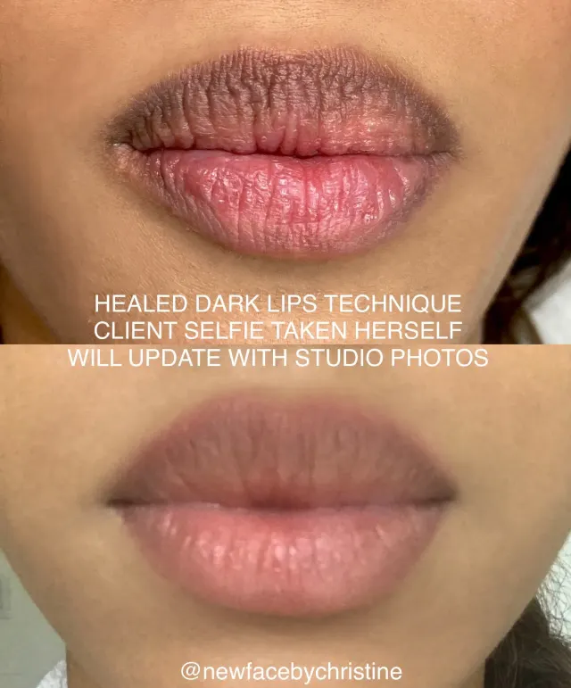 Dark Lips Neutralization result by New Face by Christine, NYC — photo 215