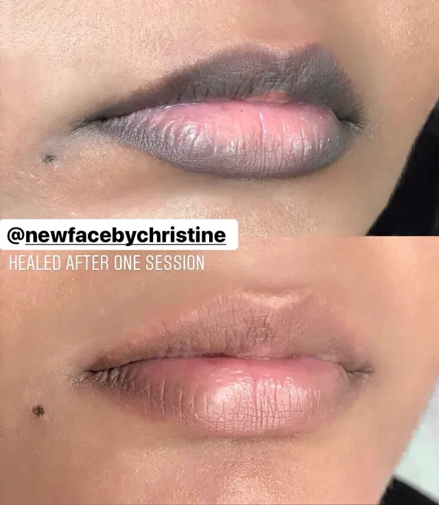 Dark Lips Neutralization result by New Face by Christine, NYC — photo 217