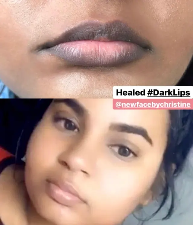Dark Lips Neutralization result by New Face by Christine, NYC — photo 218