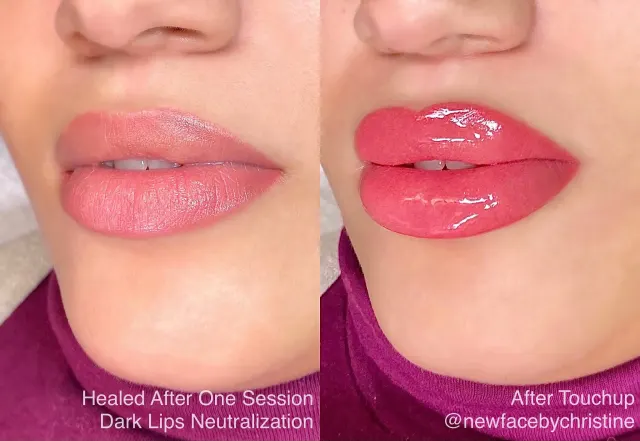 Dark Lips Neutralization result by New Face by Christine, NYC — photo 219
