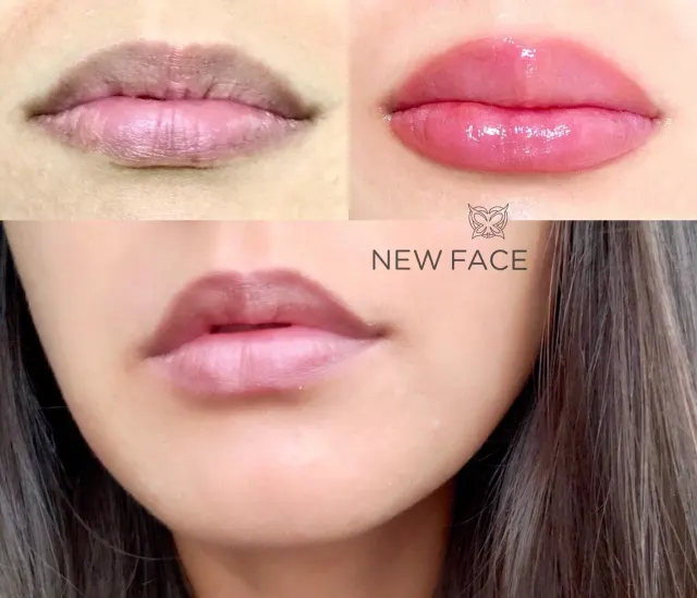 Dark Lips Neutralization result by New Face by Christine, NYC — photo 220