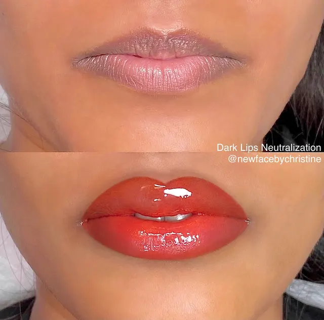 Dark Lips Neutralization result by New Face by Christine, NYC — photo 223