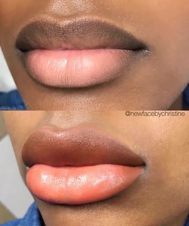 Dark Lips Neutralization result by New Face by Christine, NYC — photo 225