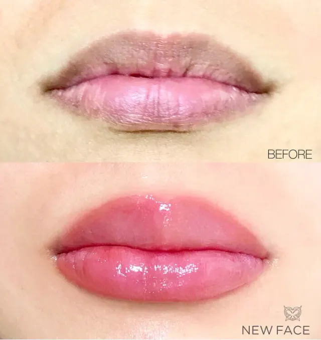 Dark Lips Neutralization result by New Face by Christine, NYC — photo 226