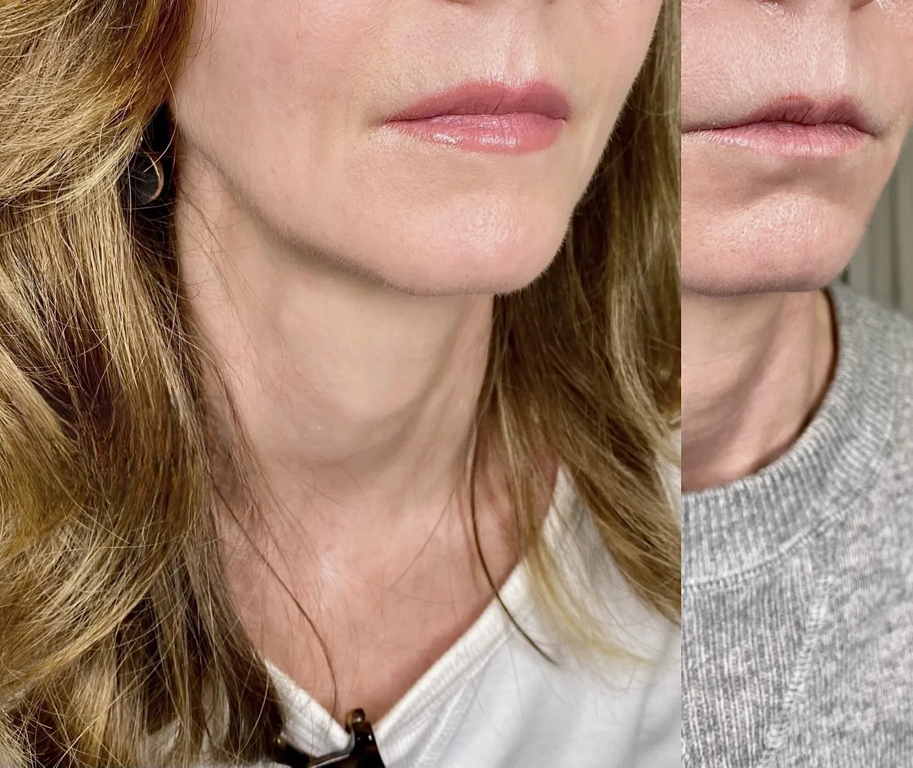Mature Lip Restoration by New Face by Christine