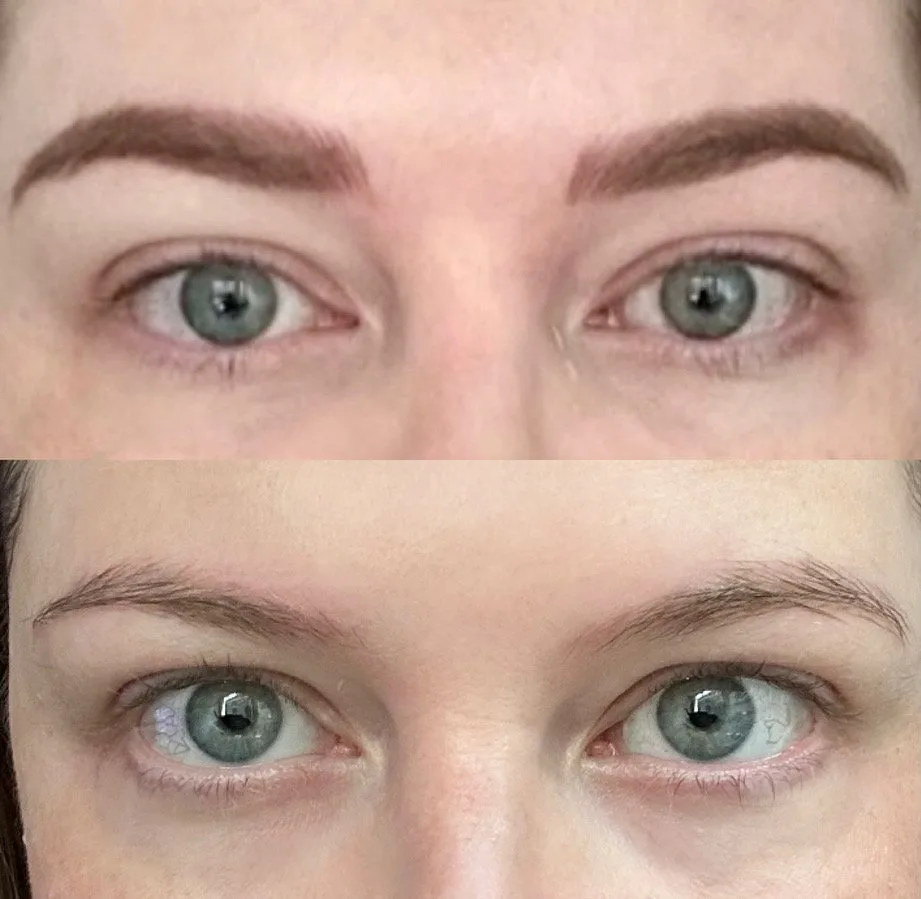 Saline Tattoo Removal by New Face by Christine