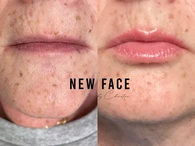 Mature Lip Restoration result by New Face by Christine, NYC — photo 2