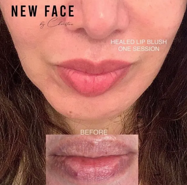 Mature Lip Restoration result by New Face by Christine, NYC — photo 3