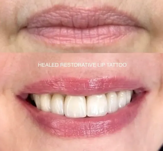 Mature Lip Restoration result by New Face by Christine, NYC — photo 4