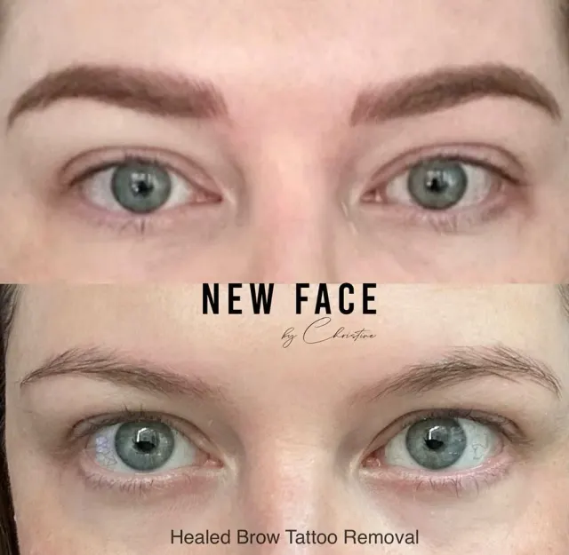 Saline Tattoo Removal result by New Face by Christine, NYC — photo 1