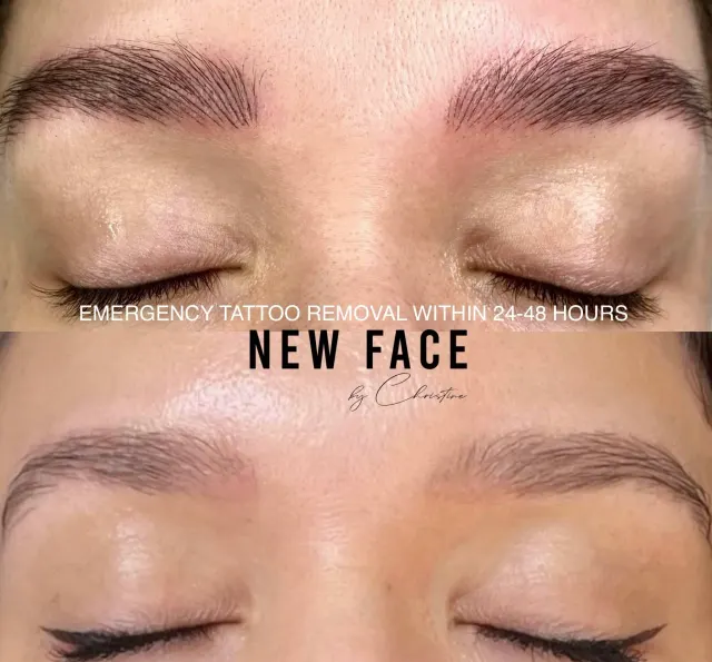 Saline Tattoo Removal result by New Face by Christine, NYC — photo 2
