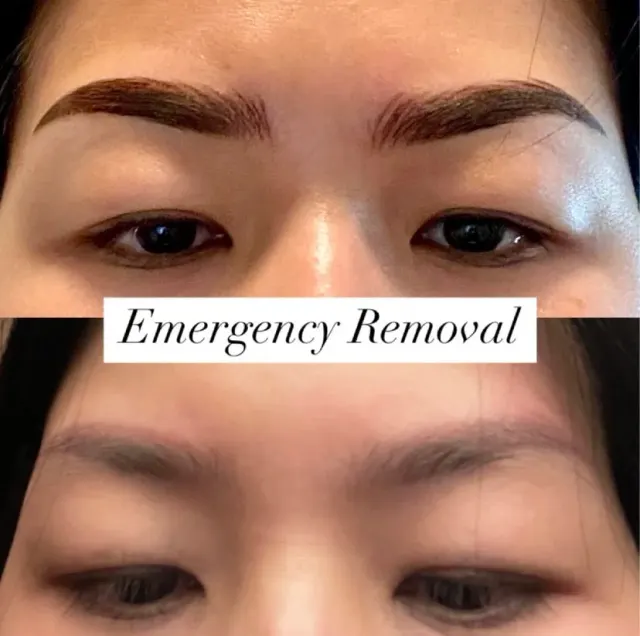 Saline Tattoo Removal result by New Face by Christine, NYC — photo 3