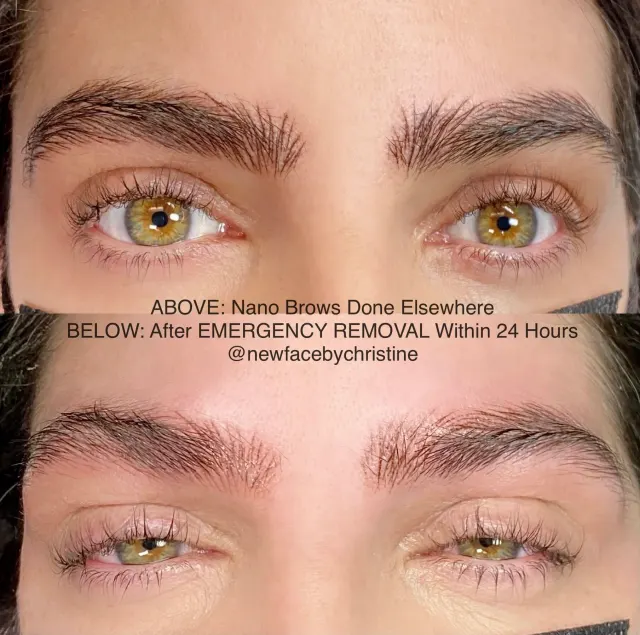 Saline Tattoo Removal result by New Face by Christine, NYC — photo 4