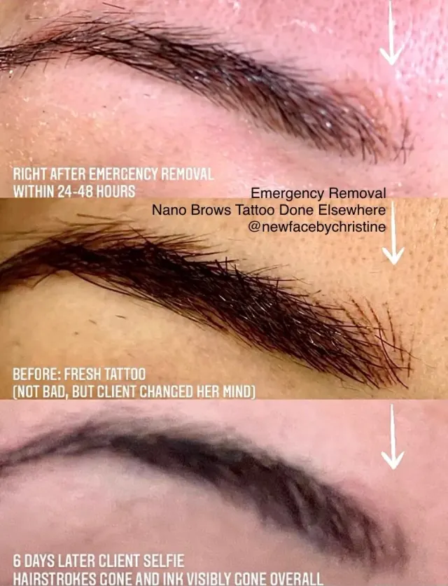 Saline Tattoo Removal result by New Face by Christine, NYC — photo 5