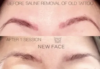 Saline Tattoo Removal result by New Face by Christine, NYC — photo 6