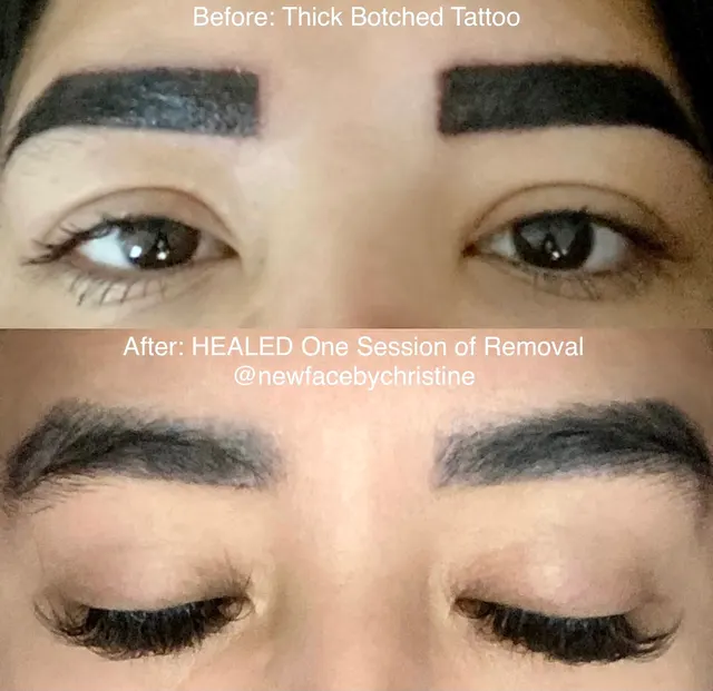 Saline Tattoo Removal result by New Face by Christine, NYC — photo 8