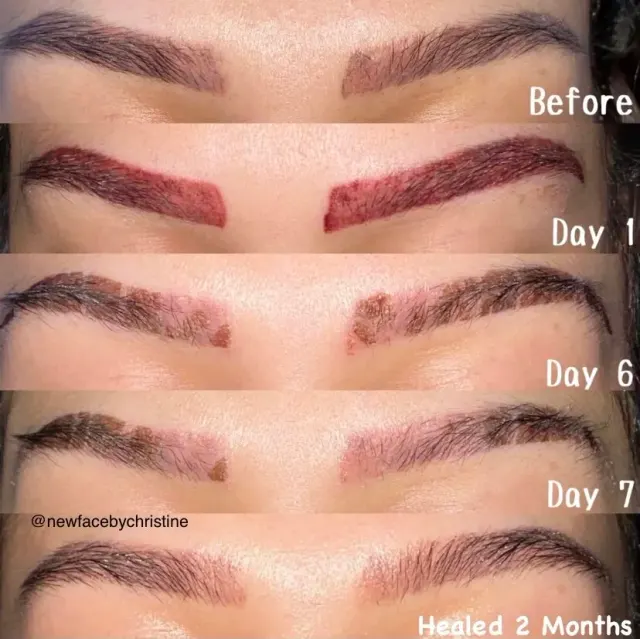 Saline Tattoo Removal result by New Face by Christine, NYC — photo 9