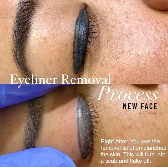Saline Tattoo Removal result by New Face by Christine, NYC — photo 10