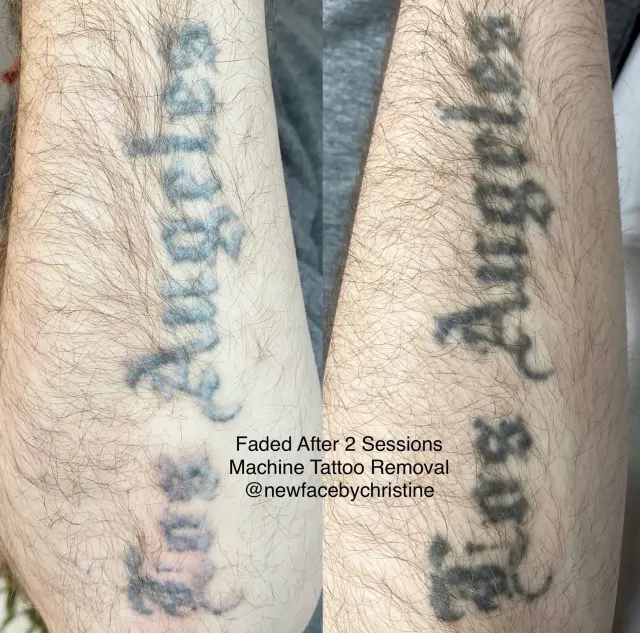 Saline Tattoo Removal result by New Face by Christine, NYC — photo 11