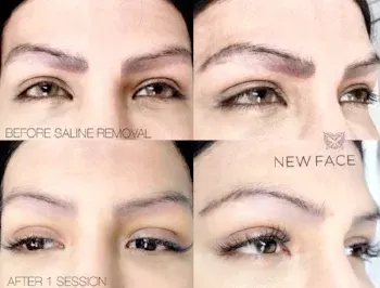 Saline Tattoo Removal result by New Face by Christine, NYC — photo 12