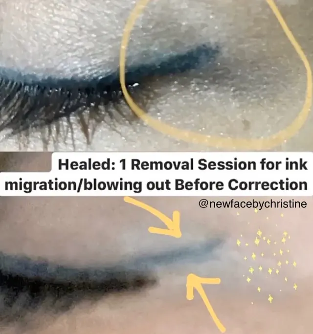 Saline Tattoo Removal result by New Face by Christine, NYC — photo 13