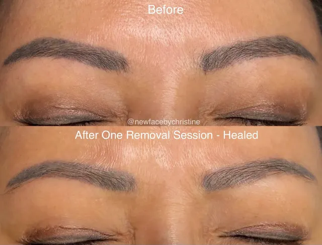 Saline Tattoo Removal result by New Face by Christine, NYC — photo 14