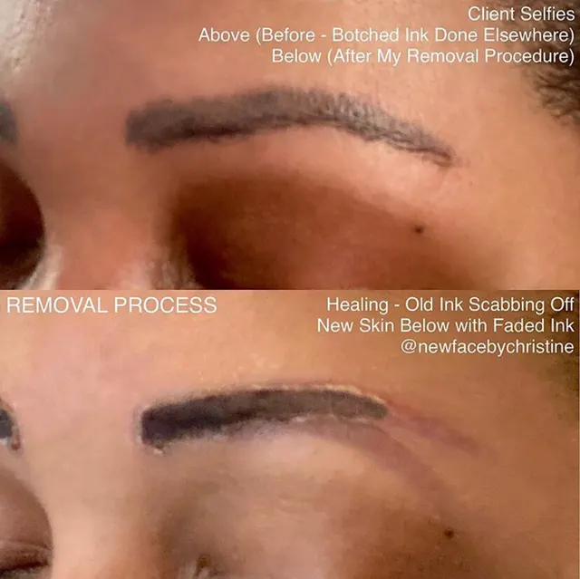 Saline Tattoo Removal result by New Face by Christine, NYC — photo 15