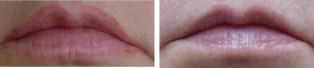 Saline Tattoo Removal result by New Face by Christine, NYC — photo 16