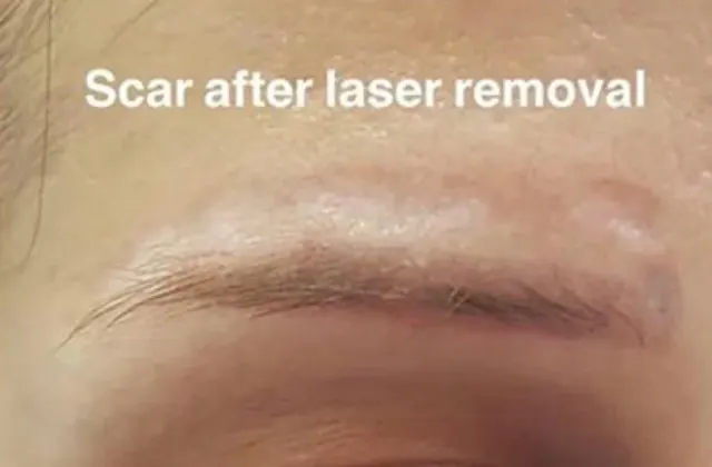 Saline Tattoo Removal result by New Face by Christine, NYC — photo 17