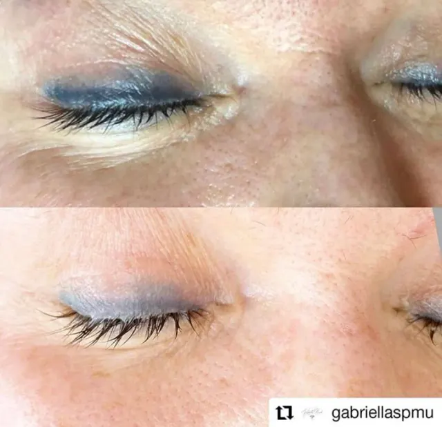 Saline Tattoo Removal result by New Face by Christine, NYC — photo 18