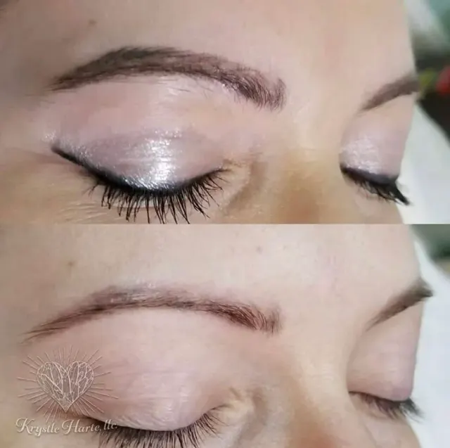 Saline Tattoo Removal result by New Face by Christine, NYC — photo 19